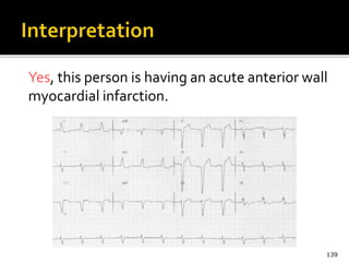 Yes, this person is having an acute anterior wall
myocardial infarction.
139
 