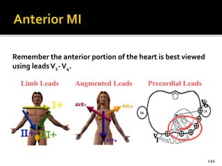 Remember the anterior portion of the heart is best viewed
using leadsV1-V4.
144
Limb Leads Augmented Leads Precordial Leads
 