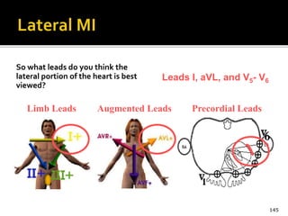 So what leads do you think the
lateral portion of the heart is best
viewed?
145
Limb Leads Augmented Leads Precordial Leads
Leads I, aVL, and V5- V6
 