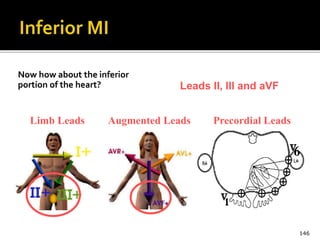 Now how about the inferior
portion of the heart?
146
Limb Leads Augmented Leads Precordial Leads
Leads II, III and aVF
 