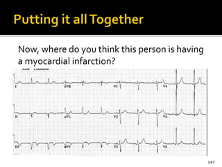 Now, where do you think this person is having
a myocardial infarction?
147
 