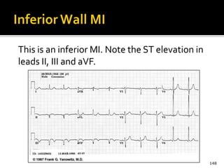 This is an inferior MI. Note the ST elevation in
leads II, III and aVF.
148
 