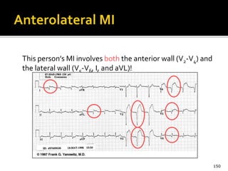 This person’s MI involves both the anterior wall (V2-V4) and
the lateral wall (V5-V6, I, and aVL)!
150
 