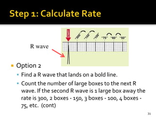  Option 2
 Find a R wave that lands on a bold line.
 Count the number of large boxes to the next R
wave. If the second R wave is 1 large box away the
rate is 300, 2 boxes - 150, 3 boxes - 100, 4 boxes -
75, etc. (cont)
31
R wave
 