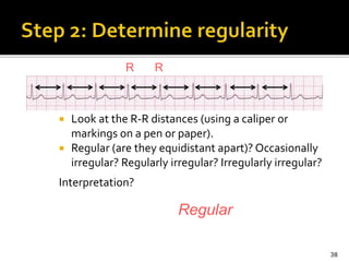  Look at the R-R distances (using a caliper or
markings on a pen or paper).
 Regular (are they equidistant apart)? Occasionally
irregular? Regularly irregular? Irregularly irregular?
Interpretation?
38
Regular
R R
 