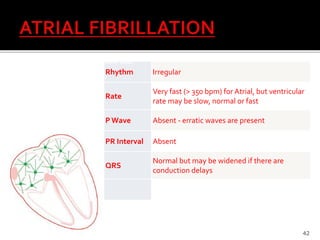 Rhythm Irregular
Rate
Very fast (> 350 bpm) for Atrial, but ventricular
rate may be slow, normal or fast
P Wave Absent - erratic waves are present
PR Interval Absent
QRS
Normal but may be widened if there are
conduction delays
42
•EKG Quick Reference Guide
 