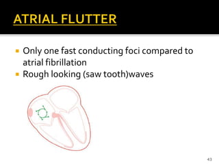  Only one fast conducting foci compared to
atrial fibrillation
 Rough looking (saw tooth)waves
43
 