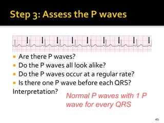  Are there P waves?
 Do the P waves all look alike?
 Do the P waves occur at a regular rate?
 Is there one P wave before each QRS?
Interpretation?
45
Normal P waves with 1 P
wave for every QRS
 
