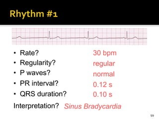 59
30 bpm• Rate?
• Regularity? regular
normal
0.10 s
• P waves?
• PR interval? 0.12 s
• QRS duration?
Interpretation? Sinus Bradycardia
 
