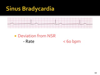  Deviation from NSR
- Rate < 60 bpm
60
 