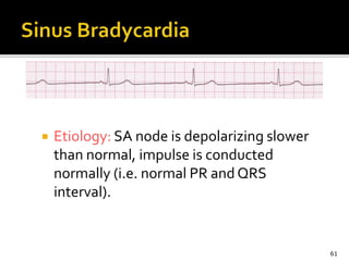  Etiology: SA node is depolarizing slower
than normal, impulse is conducted
normally (i.e. normal PR and QRS
interval).
61
 