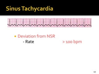  Deviation from NSR
- Rate > 100 bpm
63
 