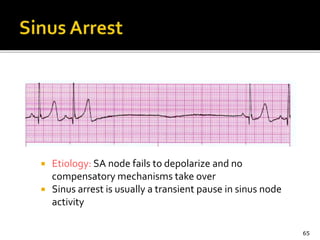  Etiology: SA node fails to depolarize and no
compensatory mechanisms take over
 Sinus arrest is usually a transient pause in sinus node
activity
65
 