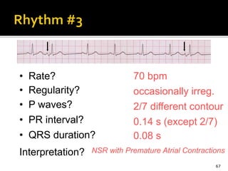 67
70 bpm• Rate?
• Regularity? occasionally irreg.
2/7 different contour
0.08 s
• P waves?
• PR interval? 0.14 s (except 2/7)
• QRS duration?
Interpretation? NSR with Premature Atrial Contractions
 