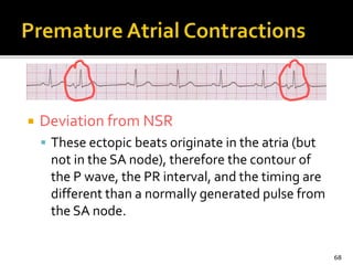  Deviation from NSR
 These ectopic beats originate in the atria (but
not in the SA node), therefore the contour of
the P wave, the PR interval, and the timing are
different than a normally generated pulse from
the SA node.
68
 