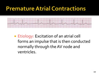  Etiology: Excitation of an atrial cell
forms an impulse that is then conducted
normally through the AV node and
ventricles.
69
 