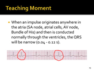  When an impulse originates anywhere in
the atria (SA node, atrial cells, AV node,
Bundle of His) and then is conducted
normally through the ventricles, the QRS
will be narrow (0.04 - 0.12 s).
70
 