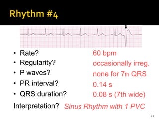 71
60 bpm• Rate?
• Regularity? occasionally irreg.
none for 7th QRS
0.08 s (7th wide)
• P waves?
• PR interval? 0.14 s
• QRS duration?
Interpretation? Sinus Rhythm with 1 PVC
 