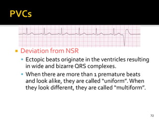  Deviation from NSR
 Ectopic beats originate in the ventricles resulting
in wide and bizarre QRS complexes.
 When there are more than 1 premature beats
and look alike, they are called “uniform”.When
they look different, they are called “multiform”.
72
 