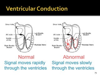 75
Normal
Signal moves rapidly
through the ventricles
Abnormal
Signal moves slowly
through the ventricles
 