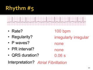 77
100 bpm• Rate?
• Regularity? irregularly irregular
none
0.06 s
• P waves?
• PR interval? none
• QRS duration?
Interpretation? Atrial Fibrillation
 