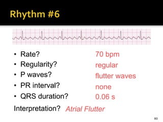 80
70 bpm• Rate?
• Regularity? regular
flutter waves
0.06 s
• P waves?
• PR interval? none
• QRS duration?
Interpretation? Atrial Flutter
 