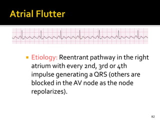  Etiology: Reentrant pathway in the right
atrium with every 2nd, 3rd or 4th
impulse generating a QRS (others are
blocked in the AV node as the node
repolarizes).
82
 