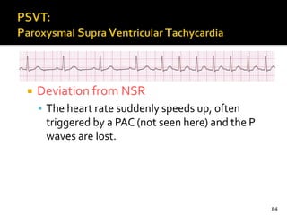  Deviation from NSR
 The heart rate suddenly speeds up, often
triggered by a PAC (not seen here) and the P
waves are lost.
84
 