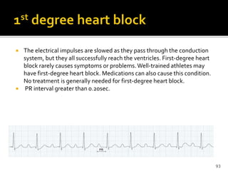  The electrical impulses are slowed as they pass through the conduction
system, but they all successfully reach the ventricles. First-degree heart
block rarely causes symptoms or problems.Well-trained athletes may
have first-degree heart block. Medications can also cause this condition.
No treatment is generally needed for first-degree heart block.
 PR interval greater than 0.20sec.
93
 