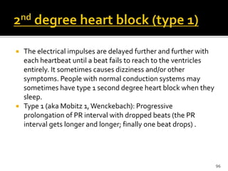  The electrical impulses are delayed further and further with
each heartbeat until a beat fails to reach to the ventricles
entirely. It sometimes causes dizziness and/or other
symptoms. People with normal conduction systems may
sometimes have type 1 second degree heart block when they
sleep.
 Type 1 (aka Mobitz 1,Wenckebach): Progressive
prolongation of PR interval with dropped beats (the PR
interval gets longer and longer; finally one beat drops) .
96
 