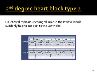 PR interval remains unchanged prior to the P wave which
suddenly fails to conduct to the ventricles.
97
 