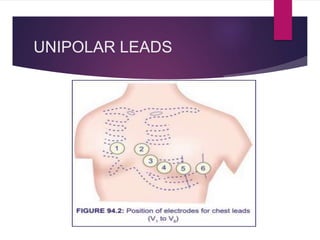 UNIPOLAR LEADS
 