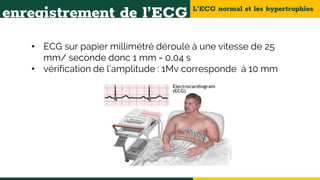 L’ECG normal et les hypertrophies
enregistrement de l’ECG
• ECG sur papier millimétré déroulé à une vitesse de 25
mm/ seconde donc 1 mm = 0,04 s
• vérification de l’amplitude : 1Mv corresponde à 10 mm
 