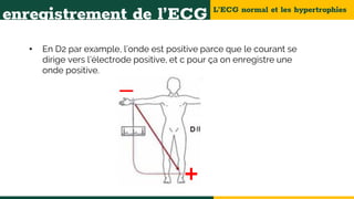 L’ECG normal et les hypertrophies
enregistrement de l’ECG
• En D2 par example, l’onde est positive parce que le courant se
dirige vers l’électrode positive, et c pour ça on enregistre une
onde positive.
 