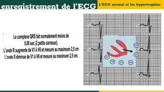 L’ECG normal et les hypertrophies
enregistrement de l’ECG
 
