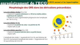 L’ECG normal et les hypertrophies
enregistrement de l’ECG
Morphologie des QRS dans les dérivations précordiales
Les précordiales droites (V1 à V3)
- Explorent la paroi antérieure du VD et la moitié antéro-
supérieure du septum.
- Aspect rS avec augmentation progressive de l’amplitude
de r de V1 à V3.
Les précordiales V3-V4
- Explorent la pointe du cœur ou pointe du VG
- Aspect qRs ou qR
Les précordiales gauches (V5 à V6)
- Explorent la paroi latérale dans sa partie basse
- Aspect qRs
L’amplitude des ondes r augmente de V1 à V5, puis diminue de
V5 à V6. Inversement l’amplitude des ondes s augmente de V1 à
V2, puis diminue de V2 à V6.
 
