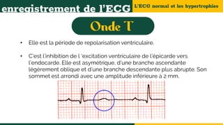 L’ECG normal et les hypertrophies
enregistrement de l’ECG
• Elle est la période de repolarisation ventriculaire.
• C’est l’inhibition de l ‘excitation ventriculaire de l’épicarde vers
l’endocarde. Elle est asymétrique, d’une branche ascendante
légèrement oblique et d’une branche descendante plus abrupte. Son
sommet est arrondi avec une amplitude inférieure à 2 mm.
 