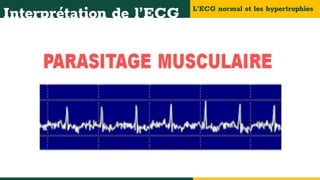 L’ECG normal et les hypertrophies
Interprétation de l’ECG
 