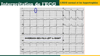 L’ECG normal et les hypertrophies
Interprétation de l’ECG
 