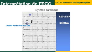 L’ECG normal et les hypertrophies
Interprétation de l’ECG
Rythme cardiaque
Chaque P est suivie d’un QRS
 