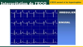L’ECG normal et les hypertrophies
Interprétation de l’ECG
 