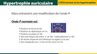 L’ECG normal et les hypertrophies
Hypertrophie auriculaire
Elles entraînent une modification de l’onde P
Onde P normale est :
Positive en D1 et en D2
Positive ou diphasique en V1.
Positive ou plate en V6.
Son axe moyen est entre 0° et +80°, habituellement à +60°
Sa durée moyenne est inférieure ou égale à 0.11 sec
Son amplitude est < 2 mm en D2, et en V1/V2
 