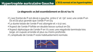 L’ECG normal et les hypertrophies
Hypertrophie auriculaire Gauche
Le diagnostic se fait essentiellement en D2 et/ou V1
L’axe frontal de P est dévié à gauche entre 0° et +30° avec une onde P en
D1 et D2 plus grande que l’onde P en D3.
La durée totale de l’onde P est allongée et > 0.12 sec.
Aspect de l’onde P bifide en double bosse surtout en D2.
Aspect diphasique de l’onde P en V1 avec une négativité terminale très
large, en cupule arrondie et plus ou moins profonde.
L’amplitude de l’onde P reste habituellement normale.
 