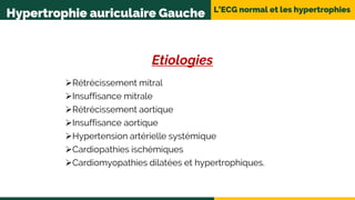L’ECG normal et les hypertrophies
Hypertrophie auriculaire Gauche
Etiologies
Rétrécissement mitral
Insuffisance mitrale
Rétrécissement aortique
Insuffisance aortique
Hypertension artérielle systémique
Cardiopathies ischémiques
Cardiomyopathies dilatées et hypertrophiques.
 