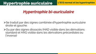 L’ECG normal et les hypertrophies
Hypertrophie auriculaire
Hypertrophie bi-auriculaire
Se traduit par des signes combinée d’hypertrophie auriculaire
droite et gauche.
Ou par des signes dissociés (HAD visible dans les dérivations
standard et HAG visible dans les dérivations précordiales ou
l’inverse)
 