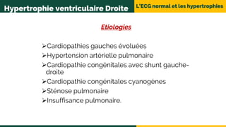 L’ECG normal et les hypertrophies
Hypertrophie ventriculaire Droite
Etiologies
Cardiopathies gauches évoluées
Hypertension artérielle pulmonaire
Cardiopathie congénitales avec shunt gauche-
droite
Cardiopathie congénitales cyanogènes
Sténose pulmonaire
Insuffisance pulmonaire.
 