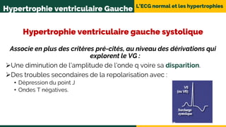 L’ECG normal et les hypertrophies
Hypertrophie ventriculaire Gauche
Hypertrophie ventriculaire gauche systolique
Associe en plus des critères pré-cités, au niveau des dérivations qui
explorent le VG :
Une diminution de l’amplitude de l’onde q voire sa disparition.
Des troubles secondaires de la repolarisation avec :
• Dépression du point J
• Ondes T négatives.
 