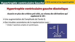 L’ECG normal et les hypertrophies
Hypertrophie ventriculaire Gauche
Hypertrophie ventriculaire gauche diastolique
Associe en plus des critères pré-cités, au niveau des dérivations qui
explorent le VG :
Une augmentation de l’amplitude de l’onde Q
Des troubles secondaires de la repolarisation avec :
• Ondes T positives amples et symétriques.
 