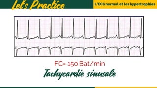 L’ECG normal et les hypertrophies
Let’s Practice
Tachycardie sinusale
FC= 150 Bat/min
 