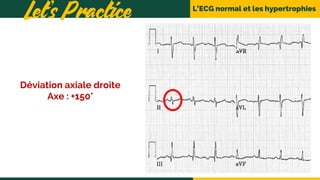 L’ECG normal et les hypertrophies
Let’s Practice
Déviation axiale droite
Axe : +150°
 
